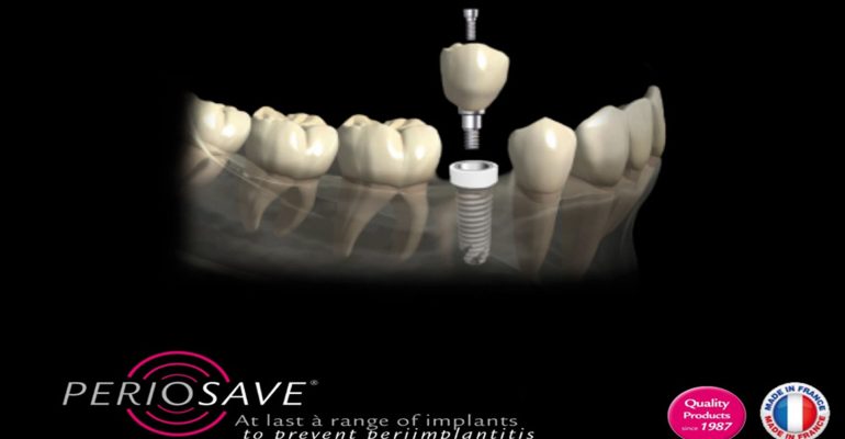 Implantes-dentales-de-zirconio,-la-mejor-elección-1920